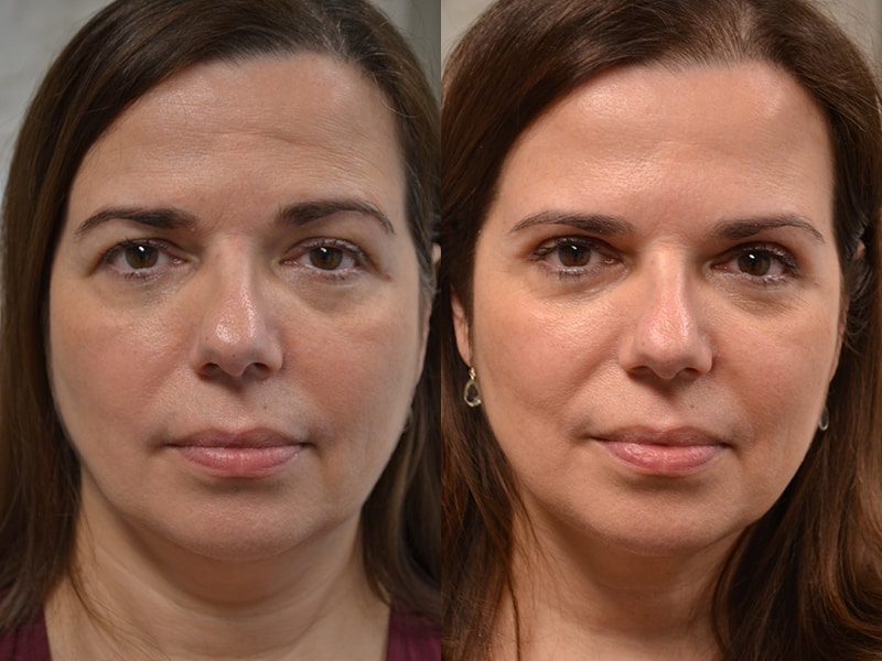 bilateral upper blepharoplasty before and after results of a woman aged 50 to 55, fixing heavy eyelids
