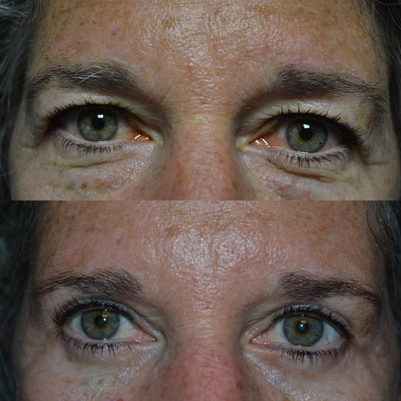woman with hazel eyes and freckles before and after for upper and lower blepharoplasty