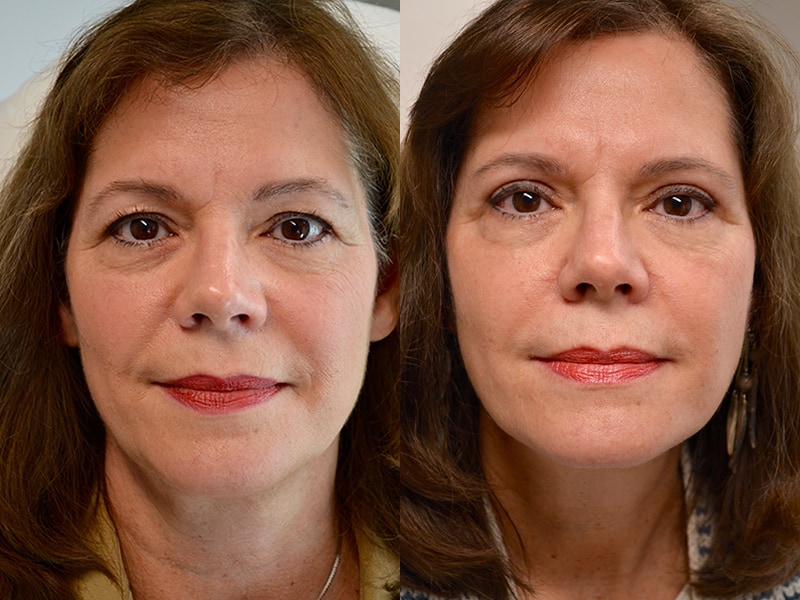 bilateral upper blepharoplasty before and after results of a woman aged 60 to 65