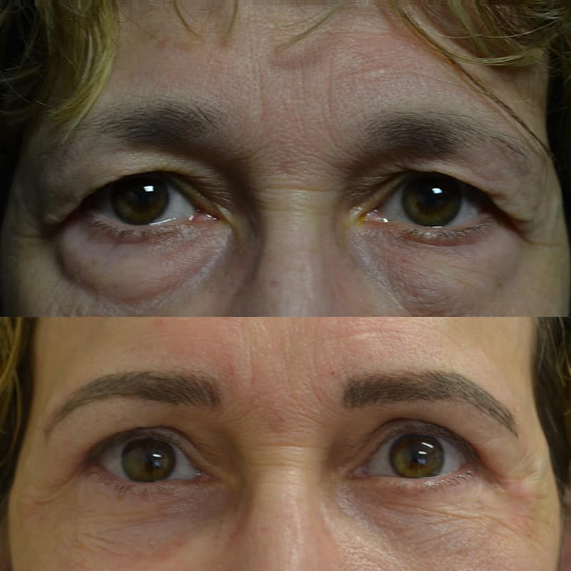 woman with droopy brown eyes before and after for upper and lower blepharoplasty