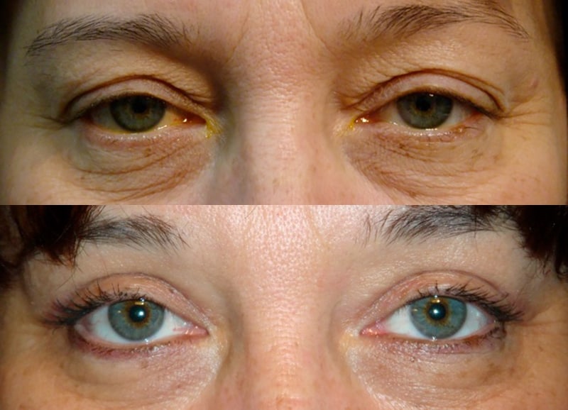 bilateral upper blepharoplasty before and after results of a woman aged 50 to 55, fixing puffy eyelids