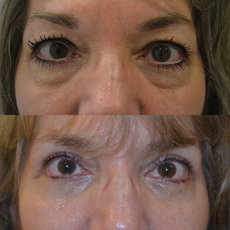 woman with brown eyes and bangs before and after for upper and lower blepharoplasty