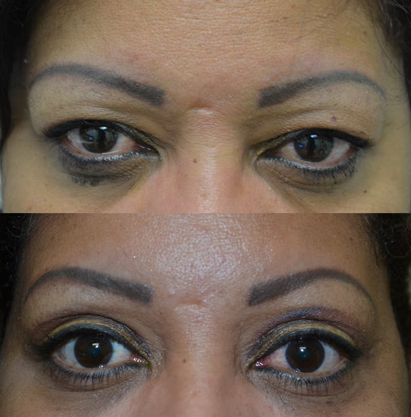 bilateral upper blepharoplasty before and after results of a woman aged 45 to 50, reducing extra skin on eyelids