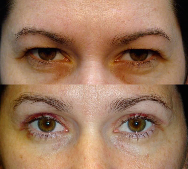bilateral upper blepharoplasty before and after results of a woman aged 30 to 35