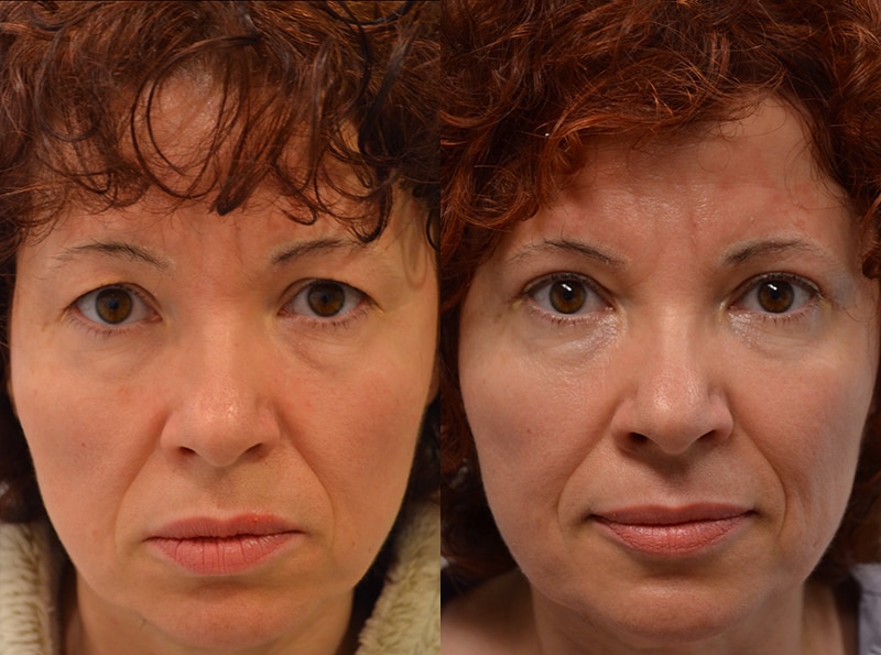 upper eyelid surgery before and after results of a woman aged 50 to 55