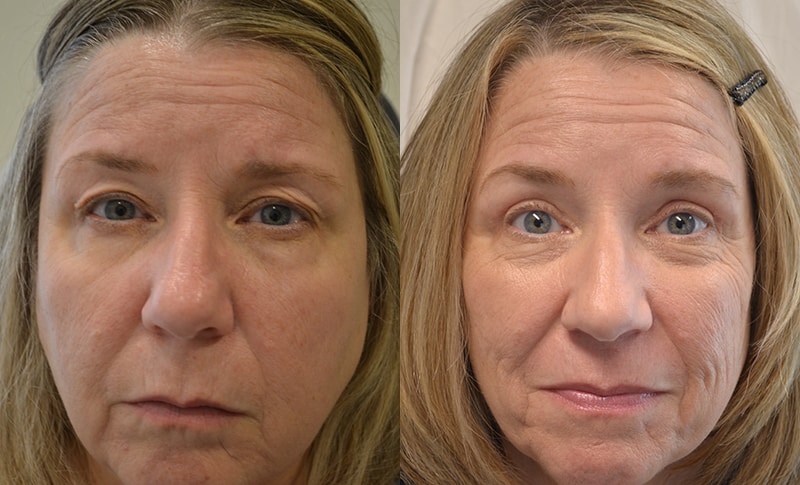 bilateral upper blepharoplasty before and after results of a woman aged 50 to 55
