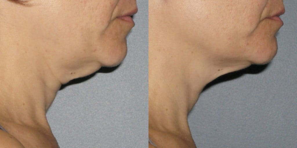 before and after of woman after ultherapy treatment on her neck