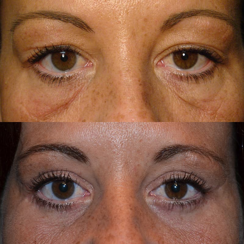 woman with brown eyes and freckles before and after for upper and lower blepharoplasty