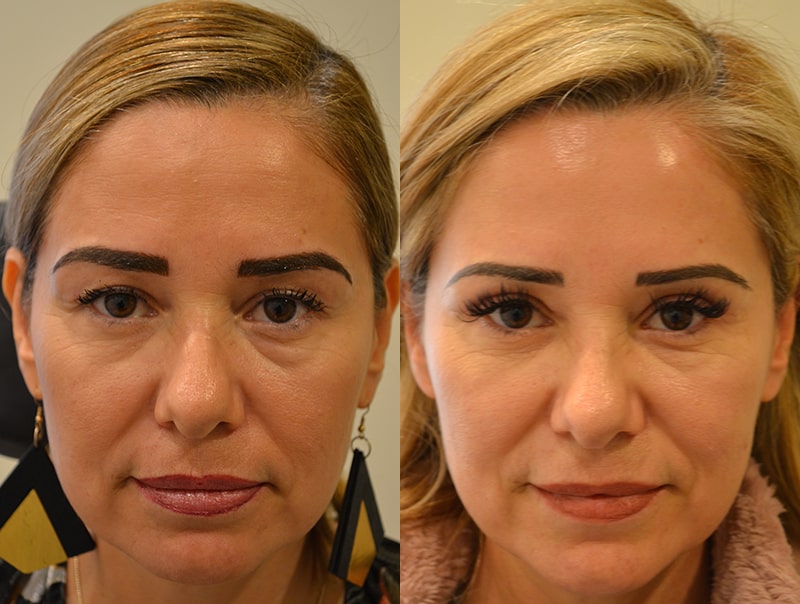 bilateral upper blepharoplasty before and after results of a woman aged 50 to 55, reducing extra skin on eyelids