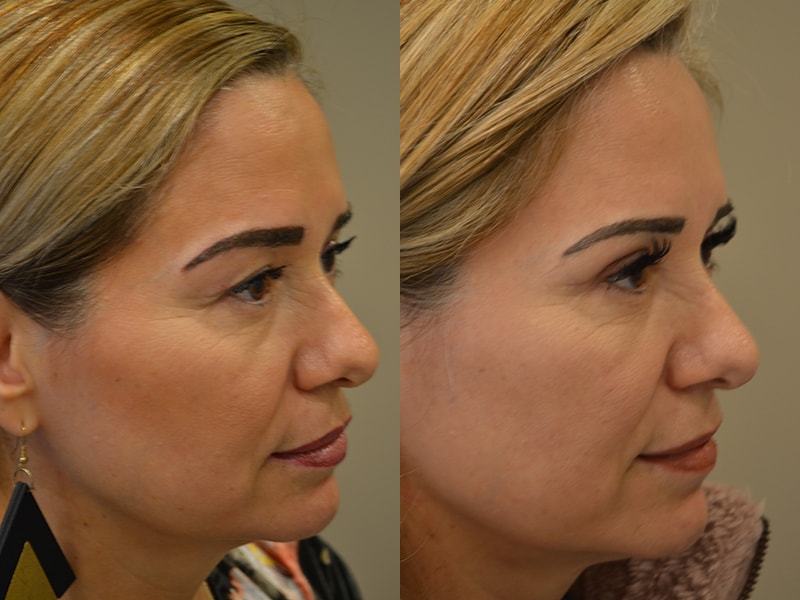bilateral upper blepharoplasty before and after results of a woman aged 50 to 55, from the right side