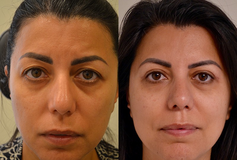 upper eyelid surgery before and after results of a woman aged 40 to 45