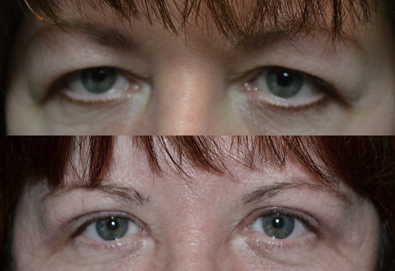 bilateral upper eyelid surgery before and after photo of a woman aged 30 to 35