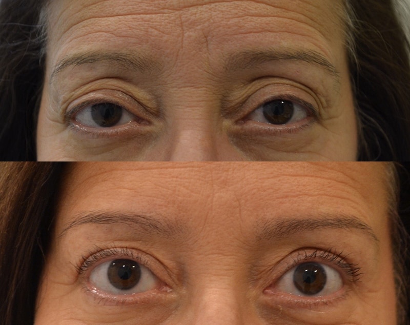 bilateral upper eyelid surgery before and after photo of a woman aged 45 to 50
