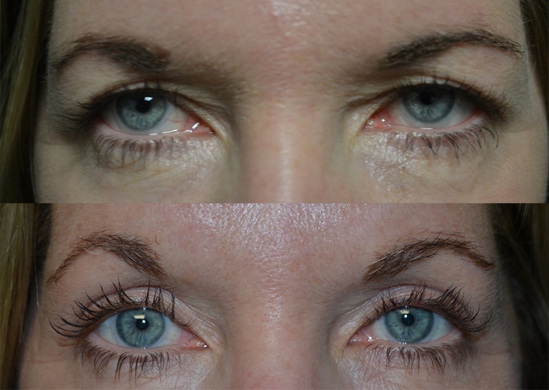 bilateral upper eyelid surgery before and after photo of a woman aged 50 to 55
