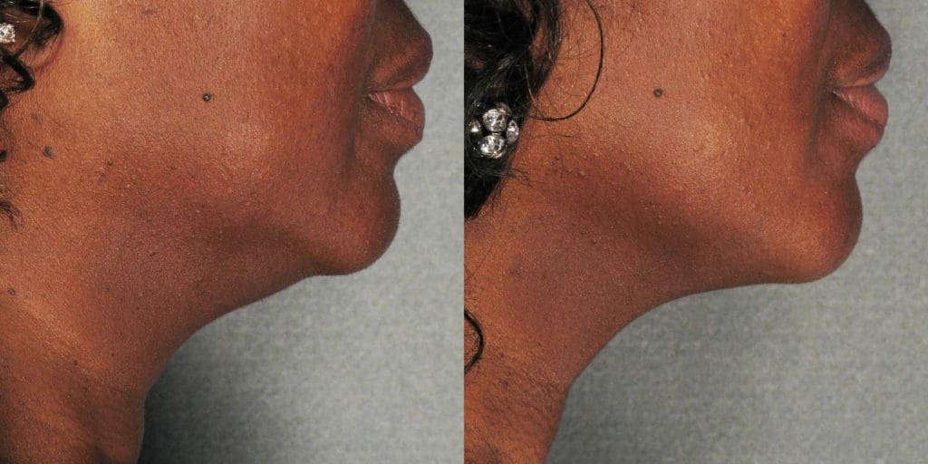 before and after of ultherapy skin tightening on a woman's neck