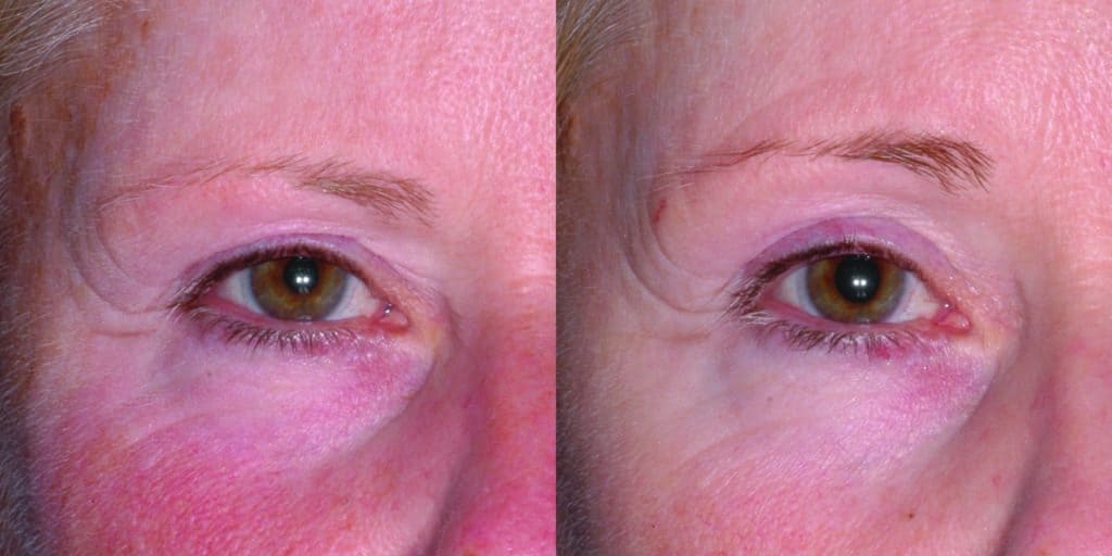 woman's before and after results for ultherapy for eyes