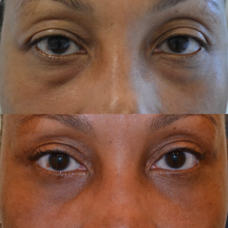 woman with brown eyes before and after for lower and upper blepharoplasty