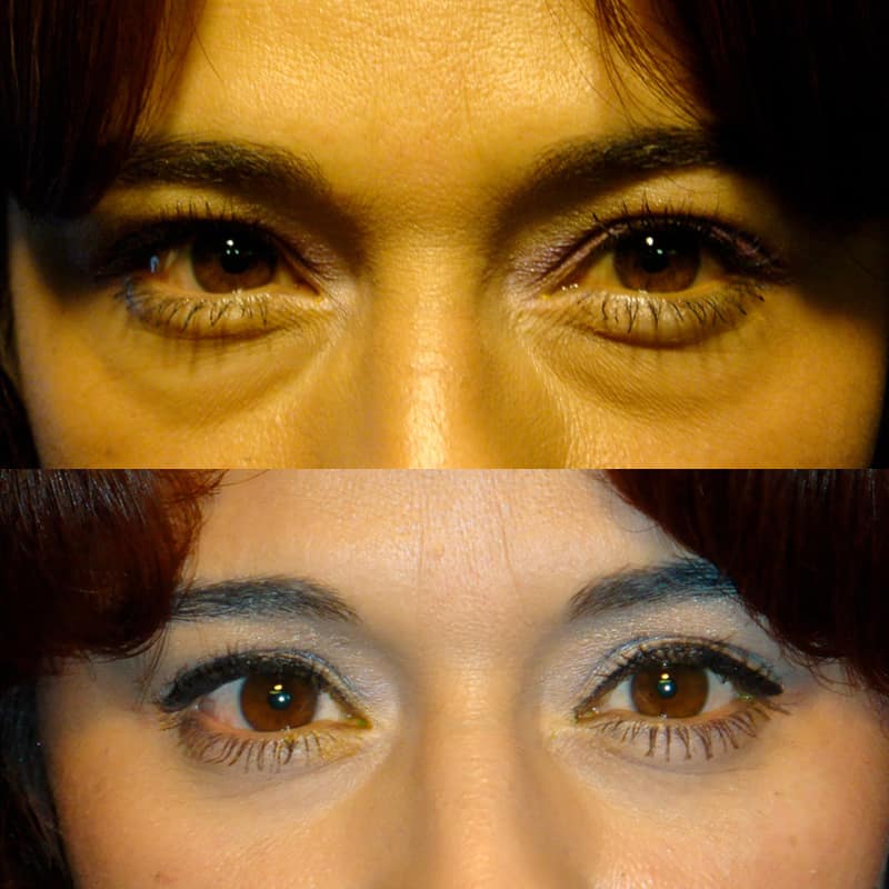 under eye blepharoplasty before and after for woman aged 30 to 35, fixing puffy bags under eyes