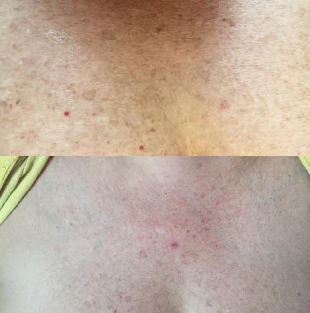 bbl laser before and after of sixty year old woman's chest, removal of sun damage and dark spots