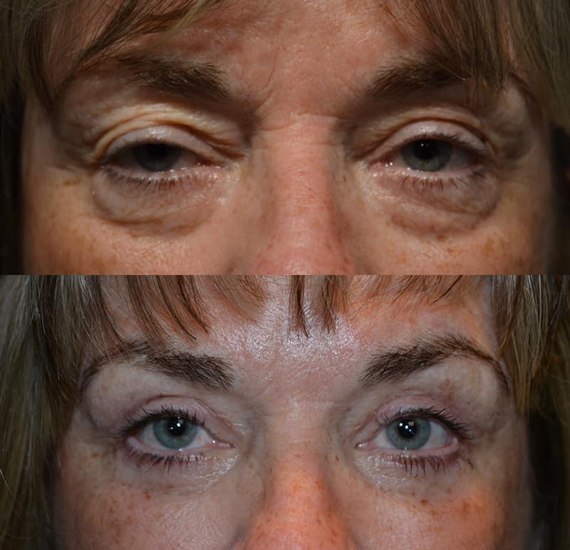 woman with blue eyes and freckles before and after for upper and lower blepharoplasty