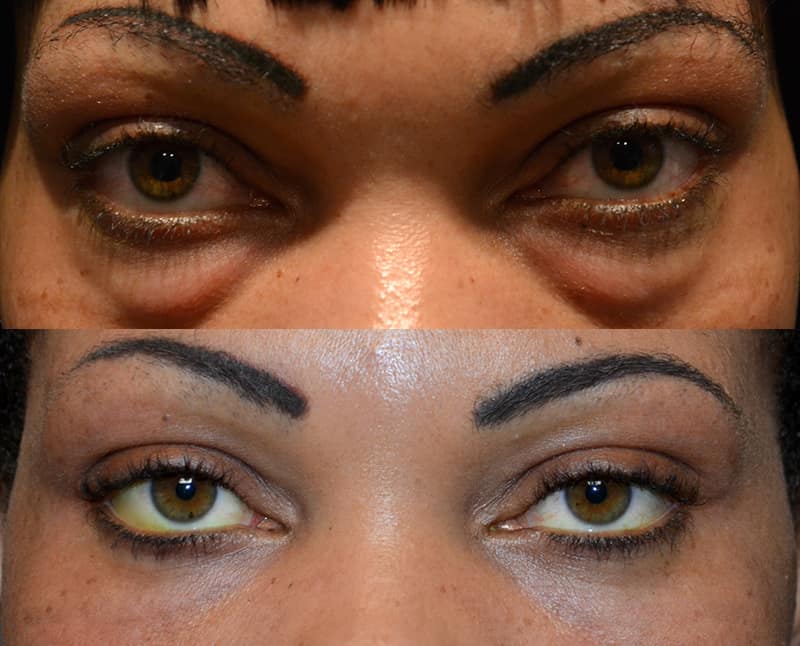 bilateral lower eyelid blepharoplasty before and after for woman 30 to 35 years, fixing heavy eyelids