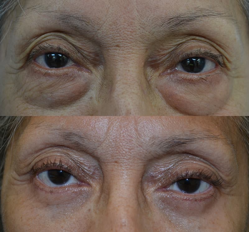 lower blepharoplasty for both eyes of woman aged 65 to 70, addressing puffy bags under eyes