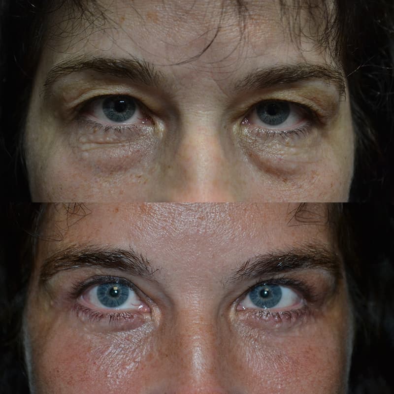 person with blue eyes before and after for upper and lower blepharoplasty