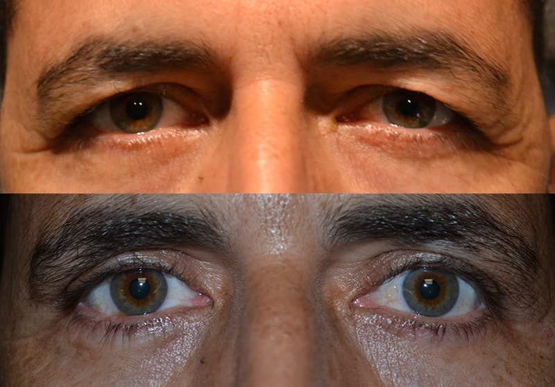 bilateral upper blepharoplasty before and after results of a man aged 50 to 55