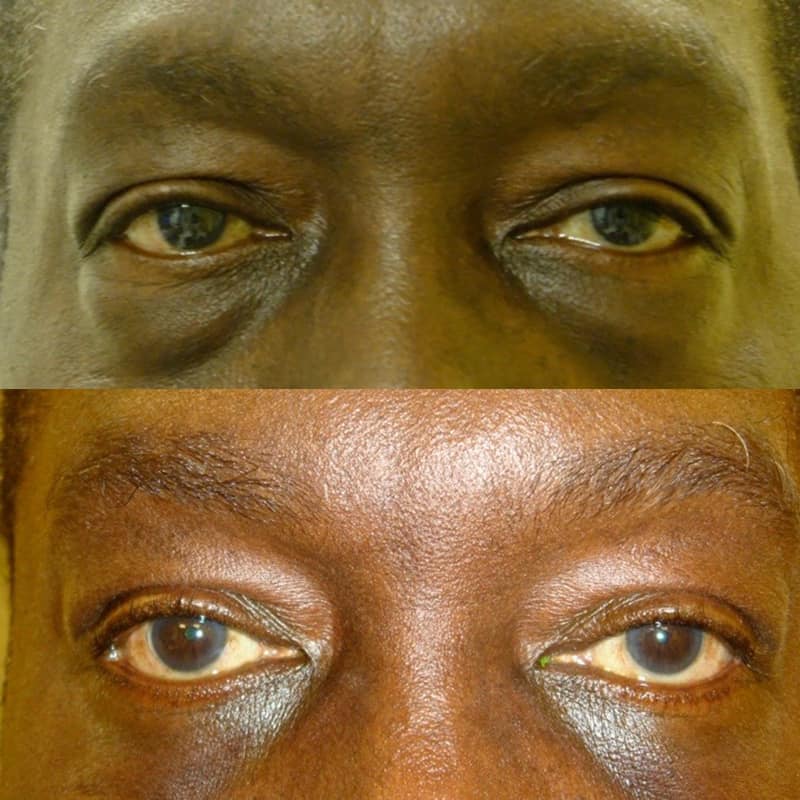 bilateral lower eyelid surgery for man aged 55 to 60, concerned about heavy eyelids