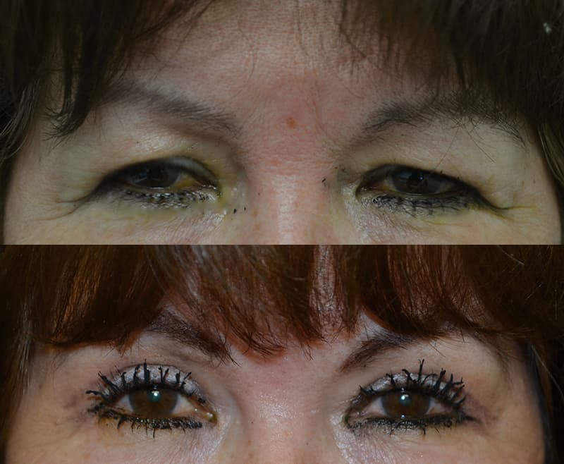 bilateral upper blepharoplasty before and after results of a woman aged 50 to 55, fixing droopy brow