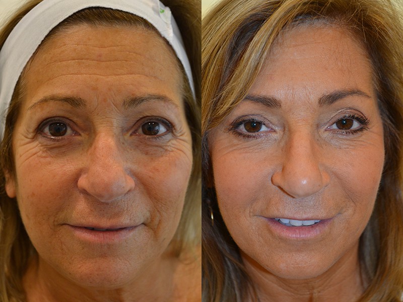 before and after combination treatment of ultherapy, botox and volbella for 50 to 55 year old woman's face