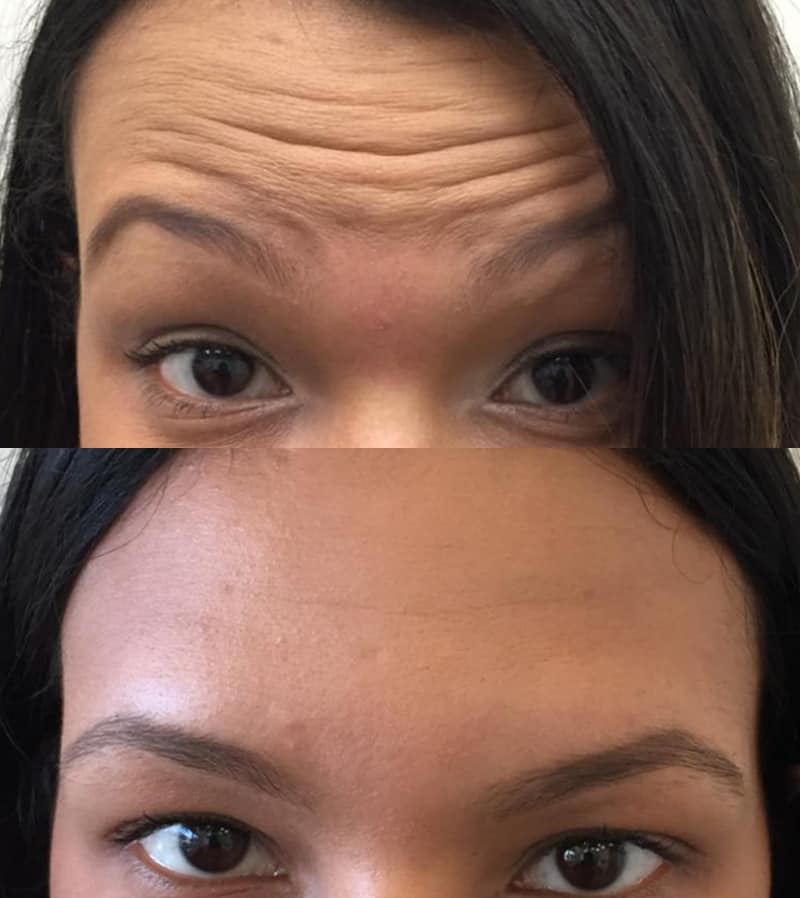 botox before and after of woman's forehead wrinkles