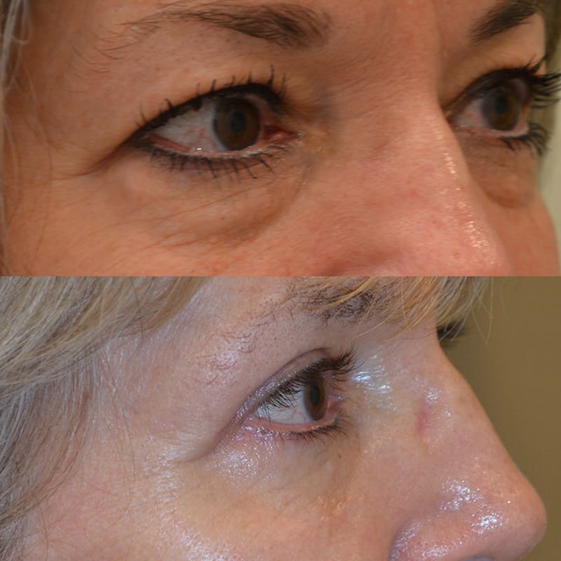 upper and lower blepharoplasty before and after for woman with brown eyes, from the right side