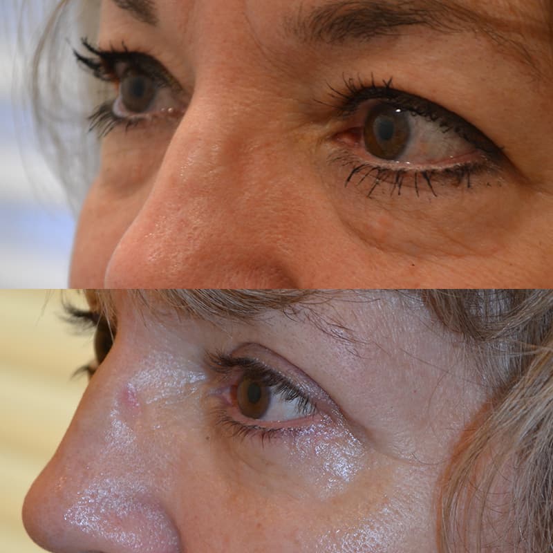 upper and lower blepharoplasty before and after for woman with brown eyes, from the left side