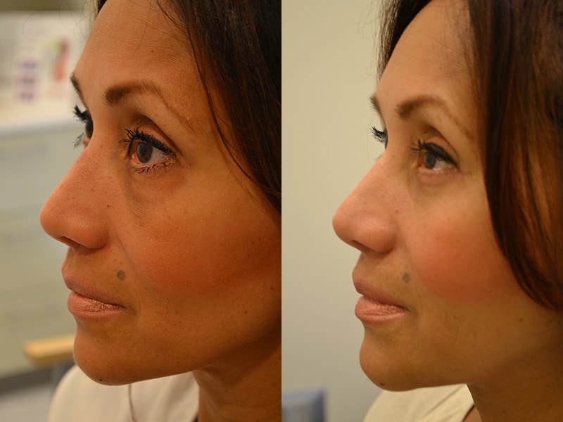 lower blepharoplasty before and after photos of a 50 year old woman's left side