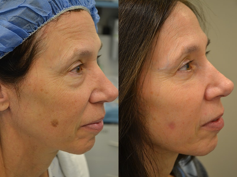lower blepharoplasty before and after photos of a 60 year old woman's right side