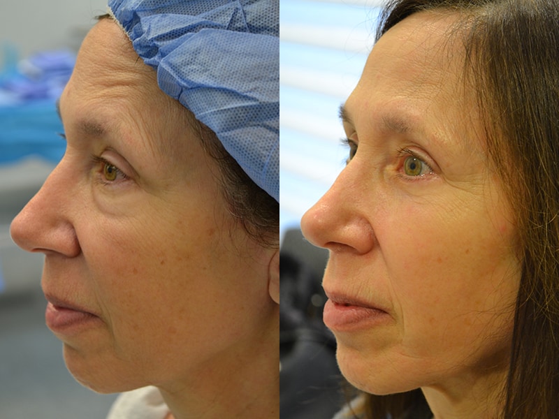 lower blepharoplasty before and after photos of a 60 year old woman's left side