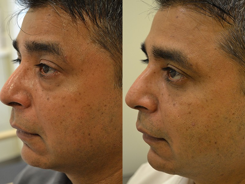 lower blepharoplasty before and after photos of a 40 year old man's left side