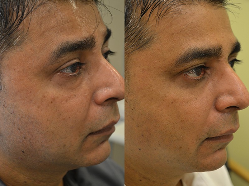 lower blepharoplasty before and after photos of a 40 year old man's right side