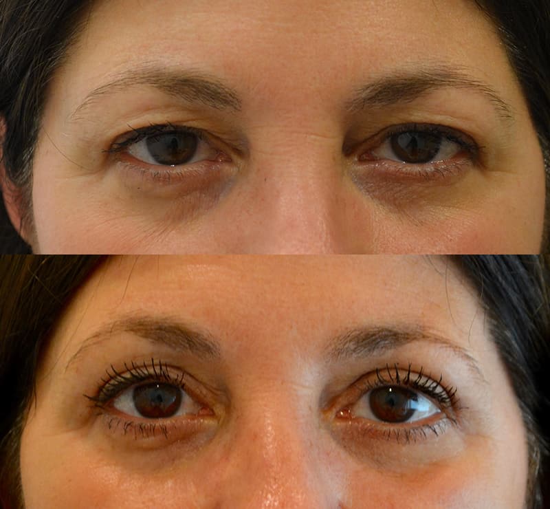 bilateral upper blepharoplasty before and after results of a woman aged 50 to 55, fixing heavy and hooded eyelids