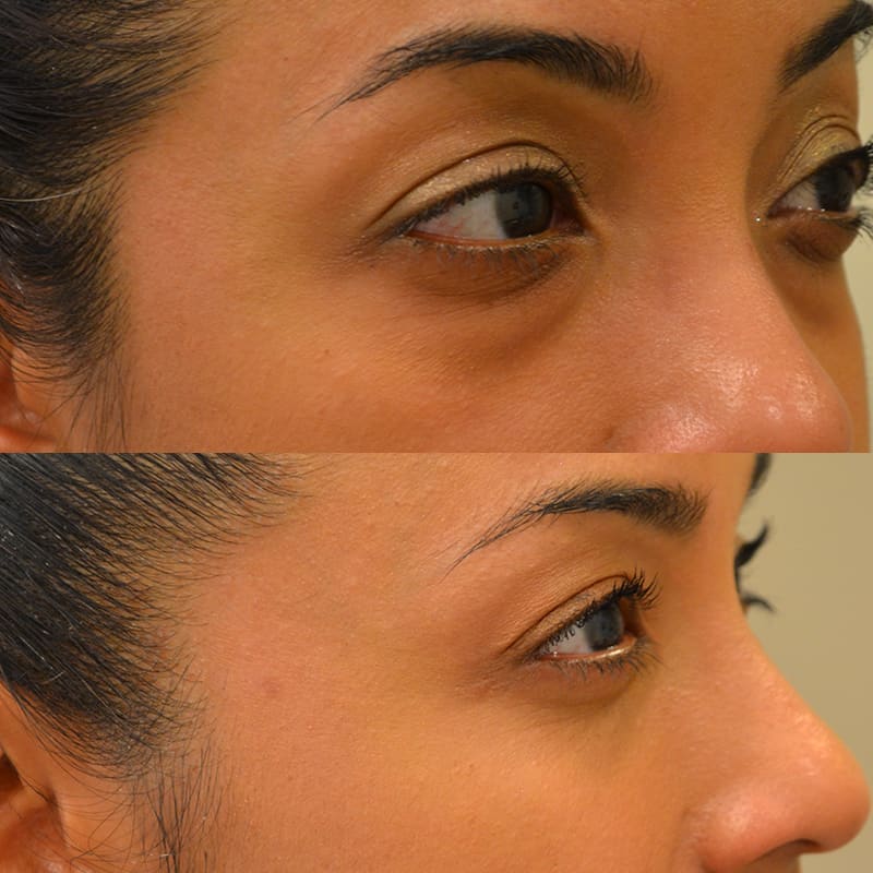 lower blepharoplasty before and after photos of a 40 year old woman's right side