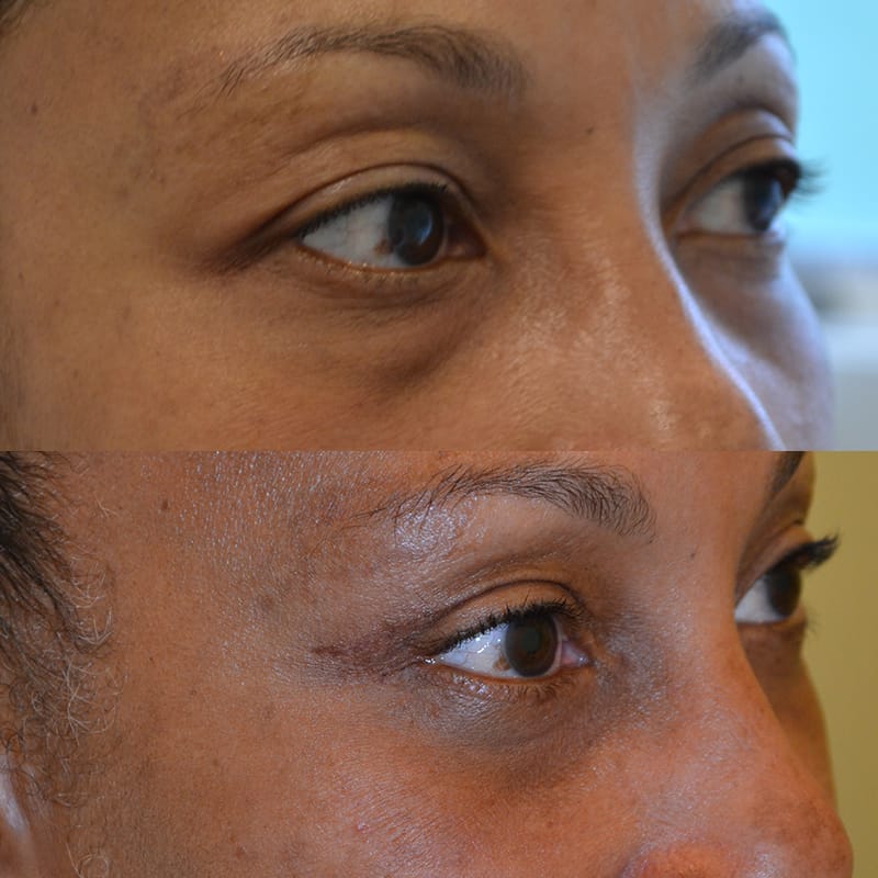 woman with brown eyes before and after for lower and upper blepharoplasty, from the right side