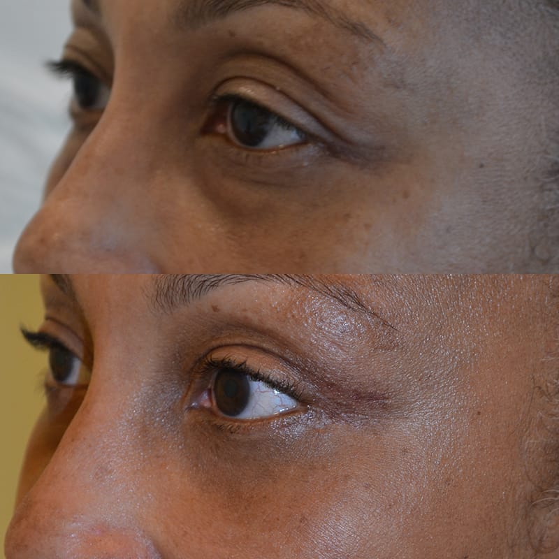 woman with brown eyes before and after for lower and upper blepharoplasty, from the left side