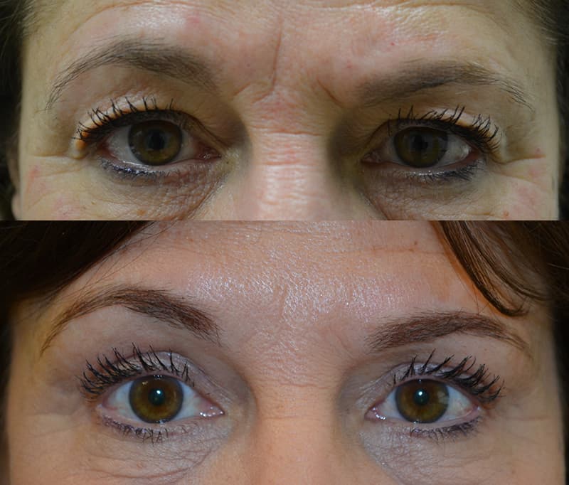 bilateral upper eyelid surgery before and after photo of a woman aged 55 to 60