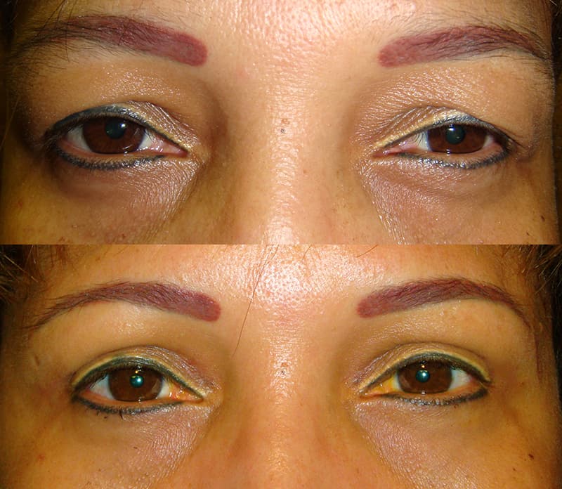 bilateral upper blepharoplasty before and after results of a woman aged 50 to 55, fixing hooded eyelids