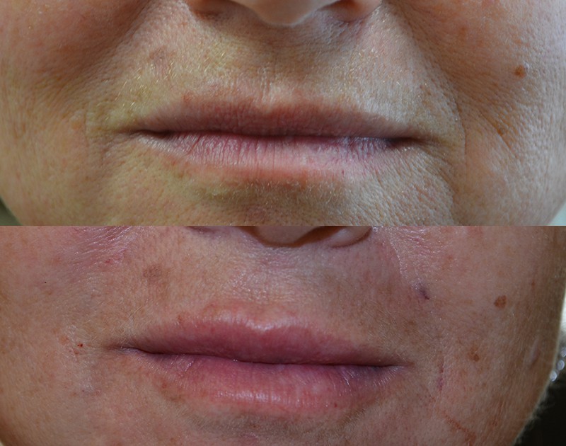 dermal filler before and after to remove fine lines around mouth