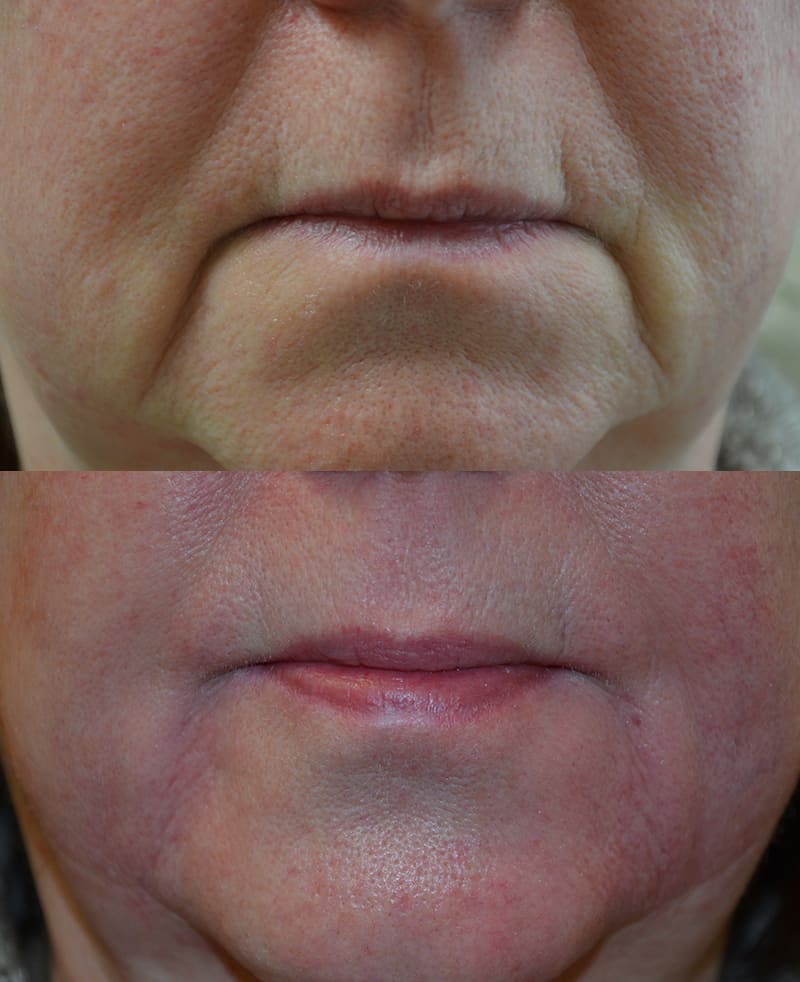 dermal fillers before and after to remove deep creases around mouth