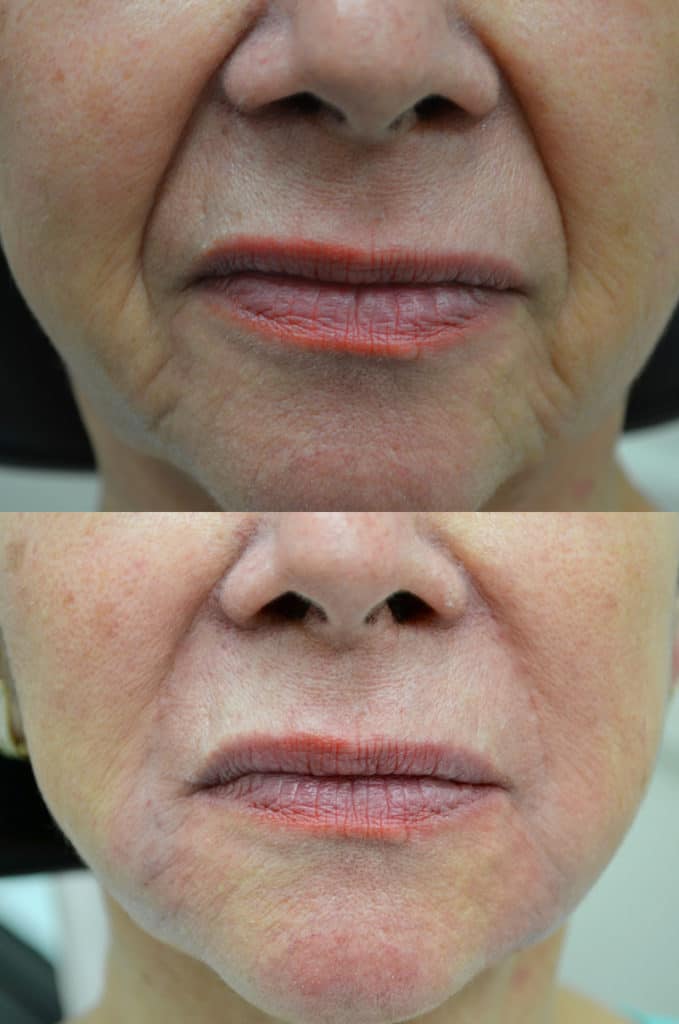 before and after dermal fillers for woman's lip, lifting sagging skin