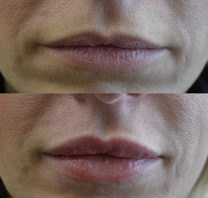 dermal fillers before and after to remove laugh lines and fill out thinning lips