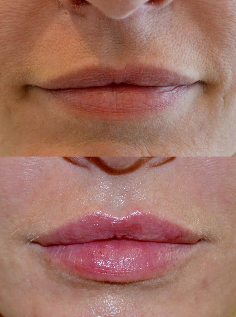 dermal filler before and after to enhance and plump a woman's lips